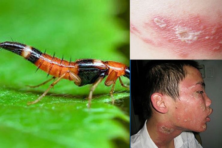 Hình ảnh tổn thương do kiến ba khoang