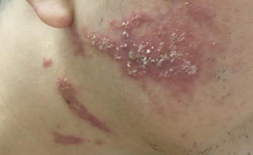 Hình ảnh tổn thương khi mới tiếp xúc chất pederin