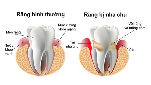 hôi miệng là biểu hiện của bệnh gì