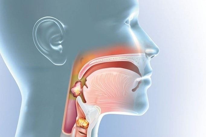 hôi miệng là biểu hiện của bệnh gì