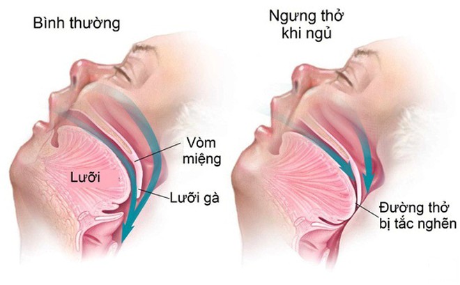 khản tiêng sau khi ngủ dậy