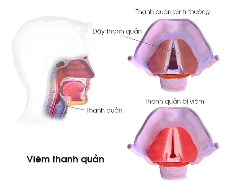 Khàn tiếng uống gì
