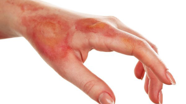 Không tự ý chọc vết phồng nước vì làm tăng nguy cơ nhiễm trùng