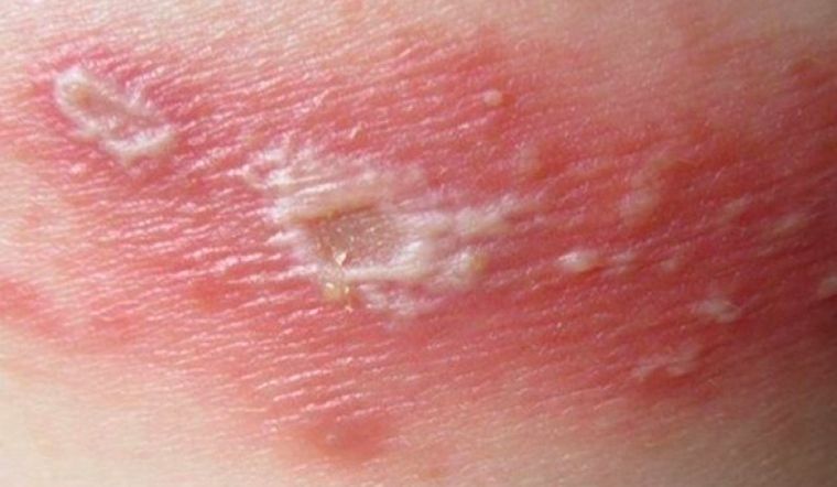 Kiến ba khoang đốt gây đau rát, ngứa ngáy