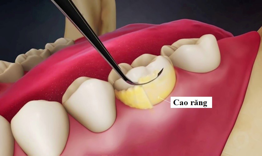 lấy cao răng bị ê buốt