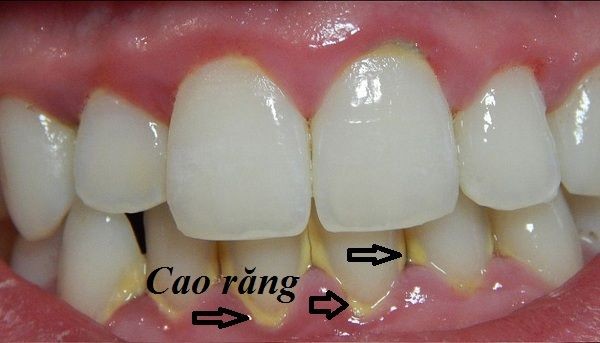 lấy cao răng nhiều có tốt không