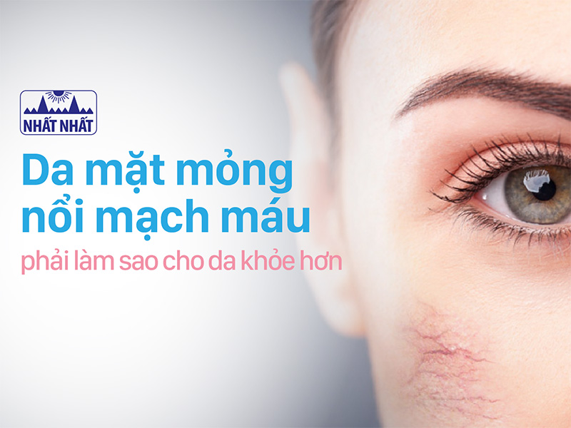 Da mỏng nổi mạch máu