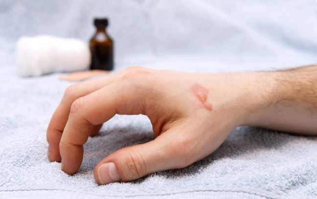 Lưu ý không nên làm vỡ vết phồng rộp do bỏng