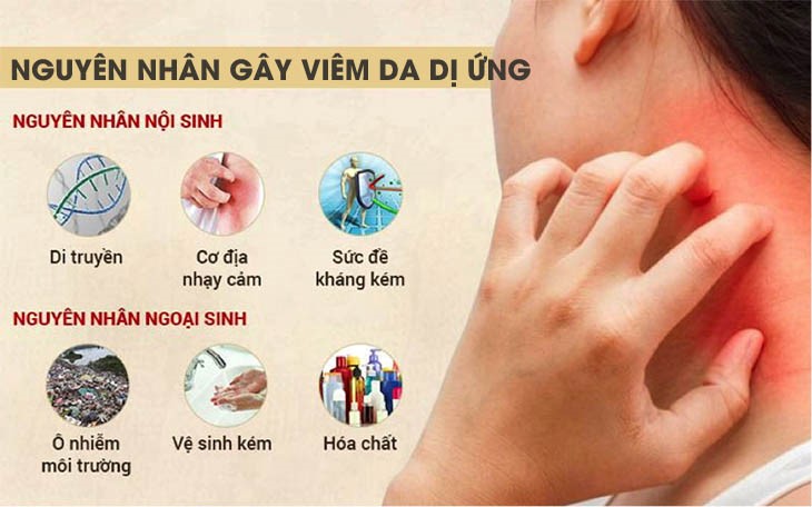 Mẩn ngứa nổi mề đay có thể do sức đề kháng kém và cơ địa nhạy cảm