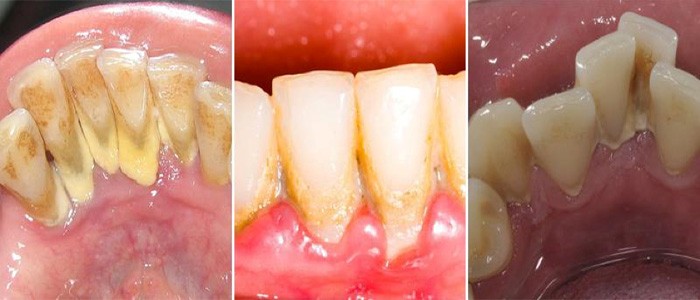 mảng bám cứng trên răng