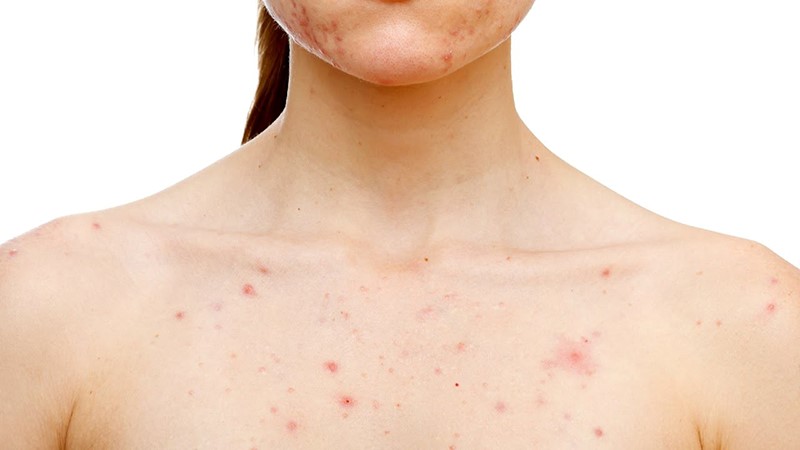 thuốc mát gan giải độc