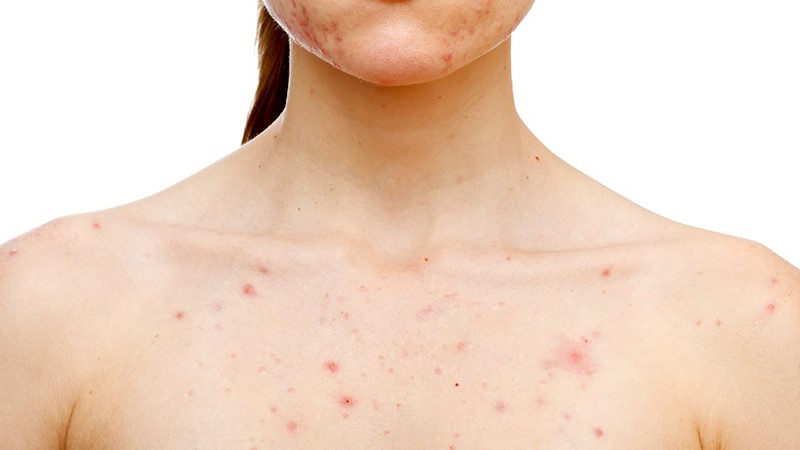 mát gan giải độc