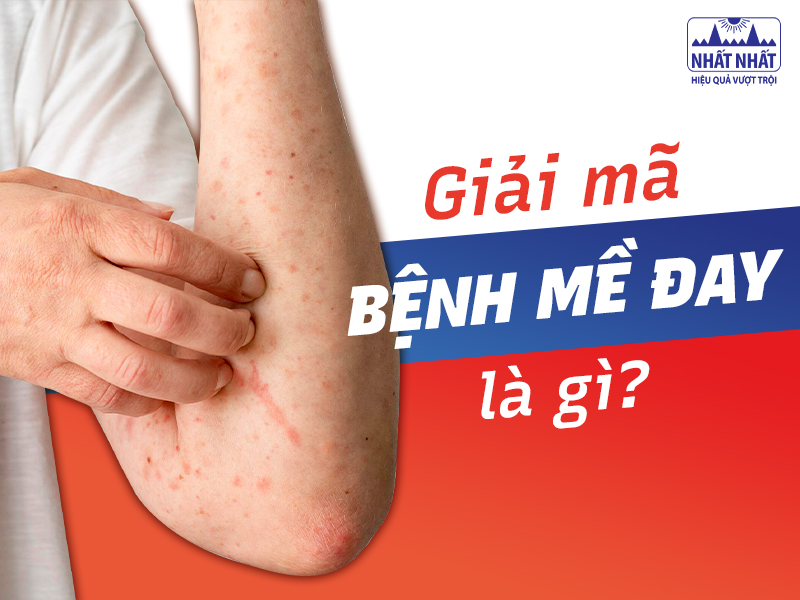 Mề đay ảnh hưởng nhiều đến sinh hoạt và công việc