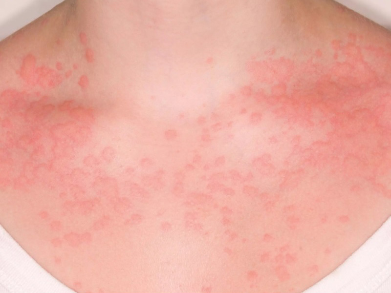 Nổi mề đay mãn tính