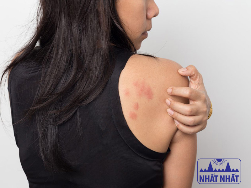 Điều trị mề đay mãn tính