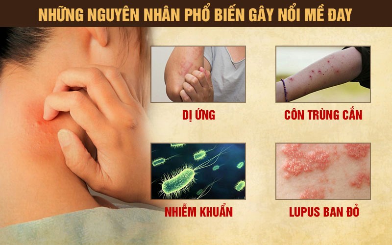mề đay mẩn ngứa