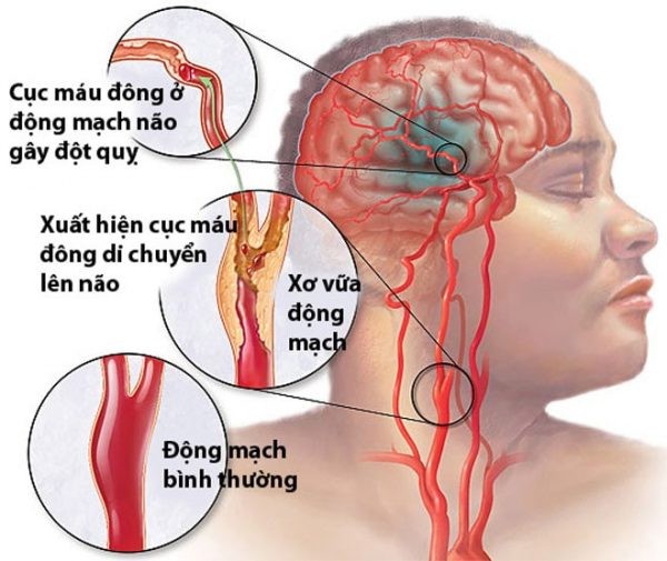 người bị mỡ máu cao