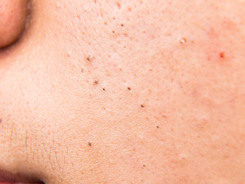 giảm mụn đầu đen