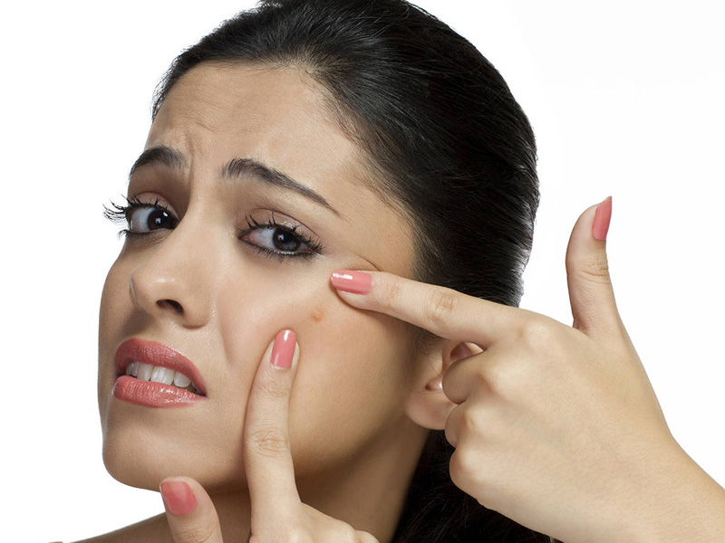 mụn trứng cá bọc