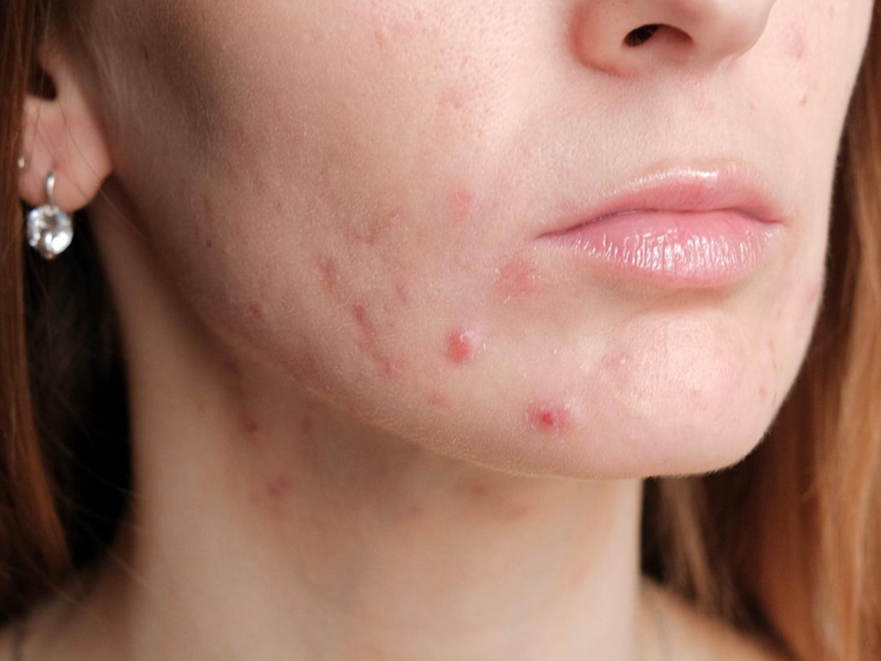 mụn trứng cá khi mang thai