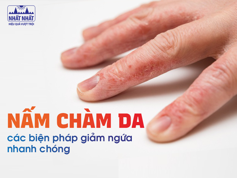 Nấm chàm da là một giai đoạn của bệnh nấm da