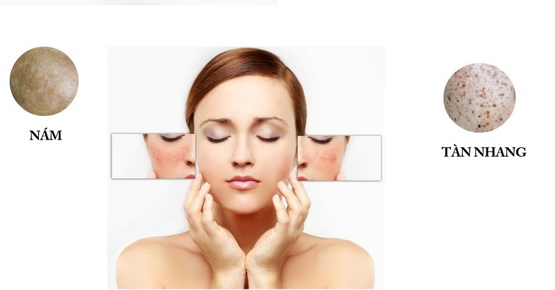 điều trị nám da và tàn nhang