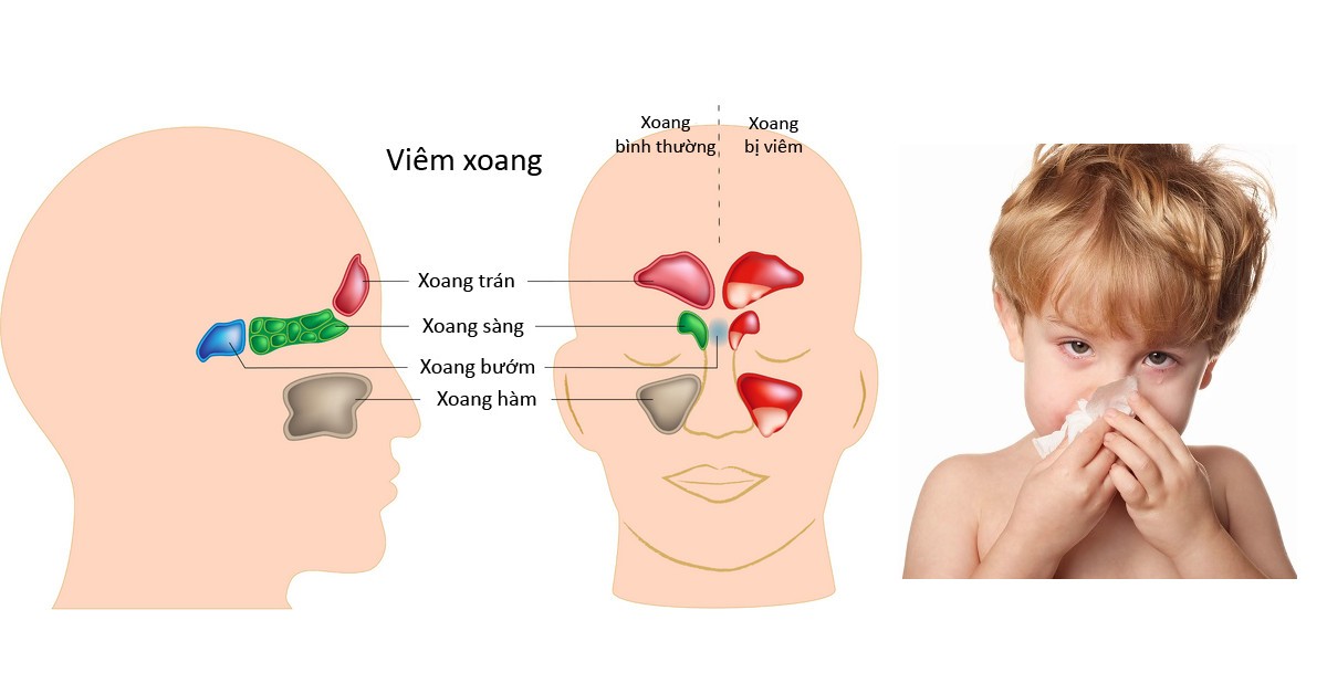 cách chữa ngạt mũi cho bé