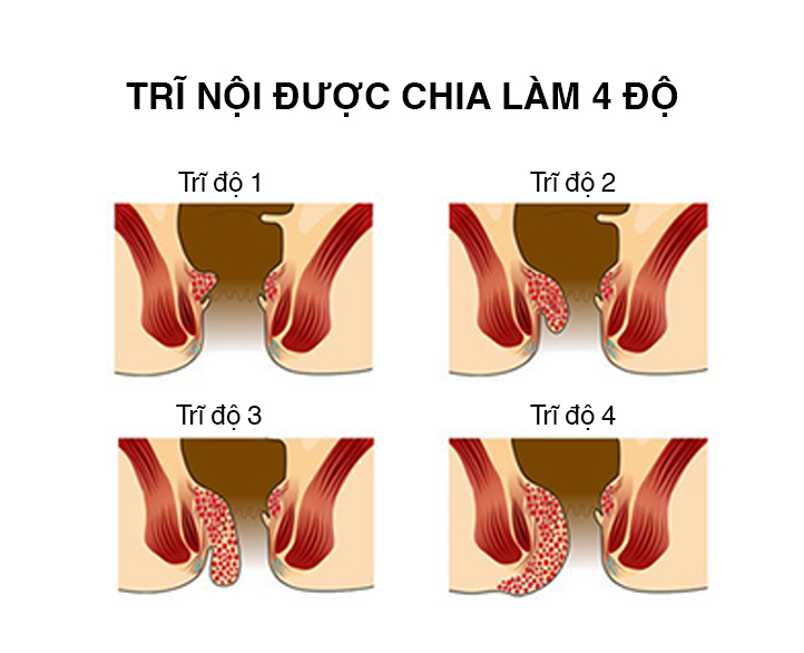Ngoài vị trí, trĩ còn được chia thành 4 mức độ