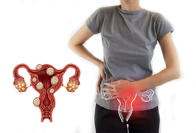 Người u xơ tử cung không nên dùng mầm đậu nành