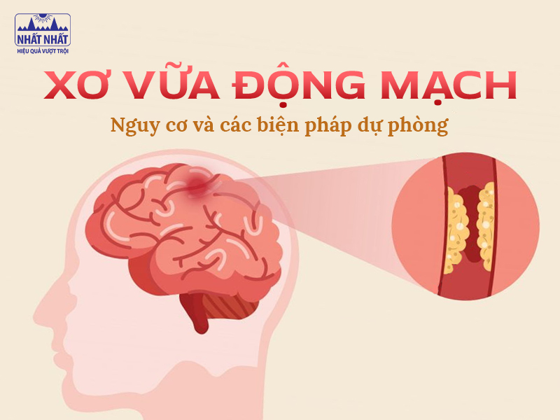 Nguy cơ và các biện pháp dự phòng xơ vừa động mạch