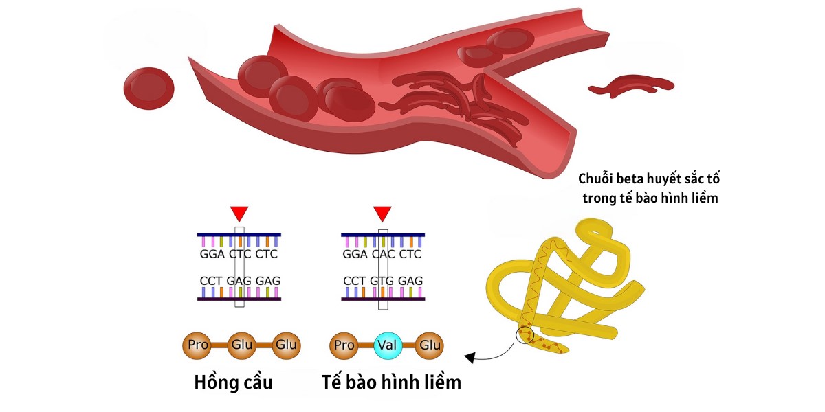 Nguyên nhân gây bệnh hồng cầu hình liềm