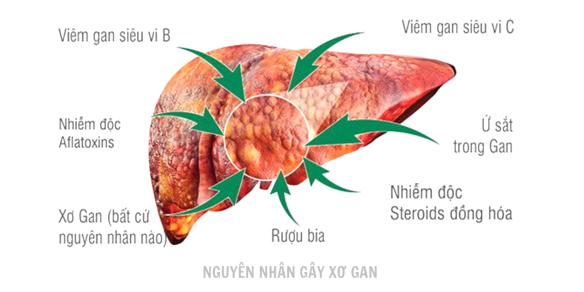 Nguyên nhân gây ung thư gan
