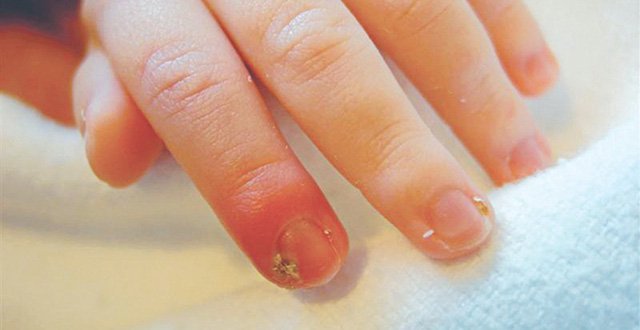 Nhiễm trùng khiến vết thương lâu lành