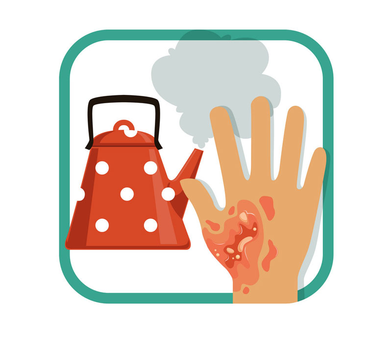 Nhiệt độ là một trong những nguyên nhân phổ biến gây bỏng