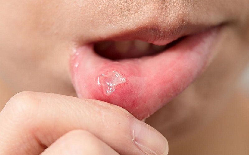 Nhiệt miệng gây đau rát khó chịu