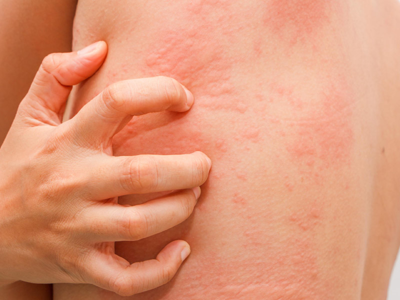 Nổi mề đay kiêng gì 