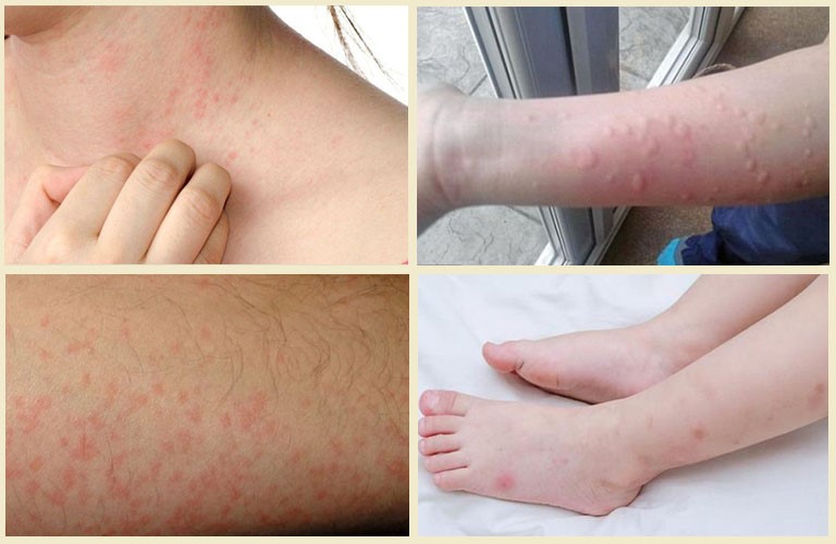 nổi mề đay