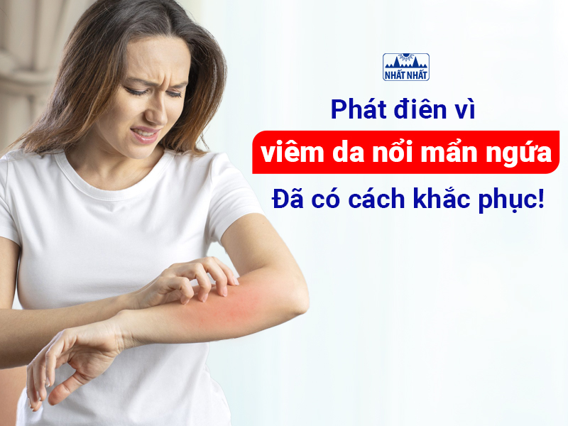 Xác định loại viêm da nổi mẩn ngứa để xử trí nhanh chóng