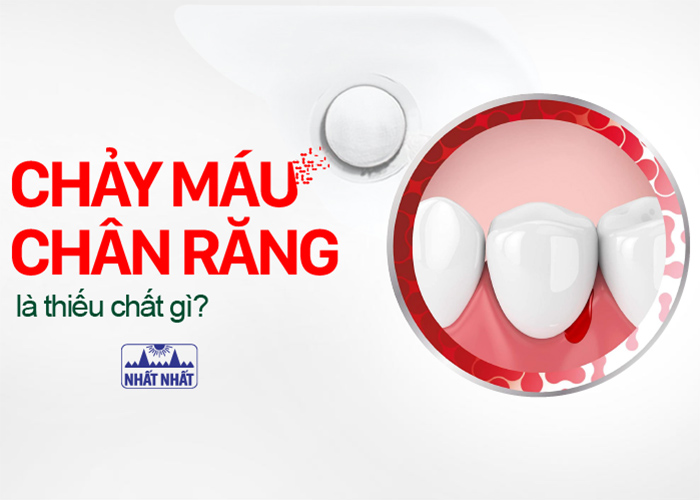 Chảy máu chân răng là thiếu chất gì
