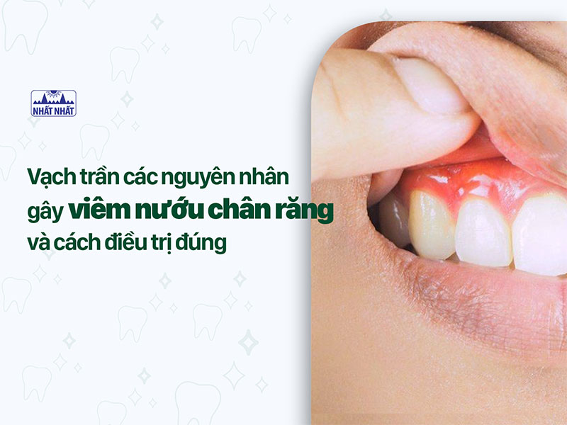 viêm nướu chân răng 