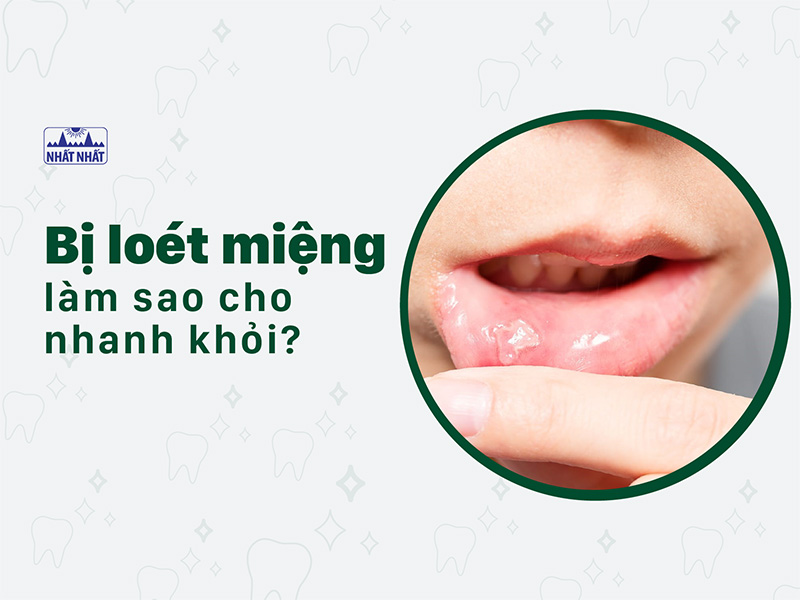 bệnh loét miệng