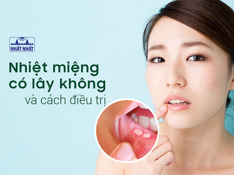 nhiệt miệng có lây không