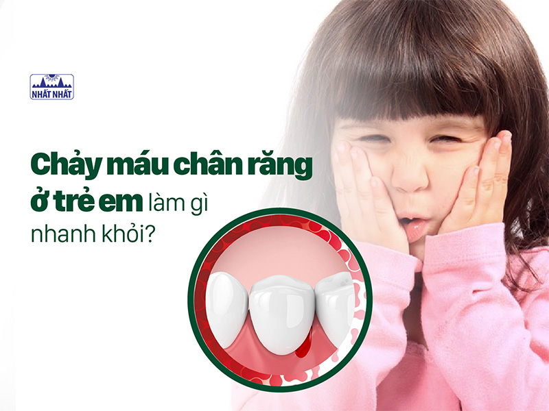 chảy máu chân răng ở trẻ em