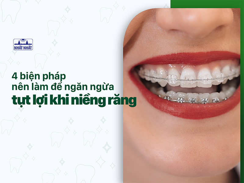 tụt lợi khi niềng răng