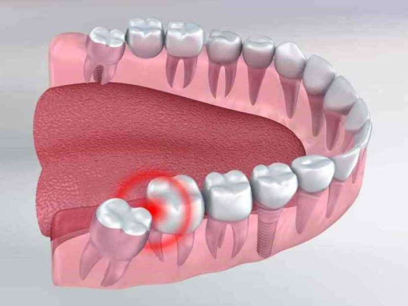đau nhức răng khôn