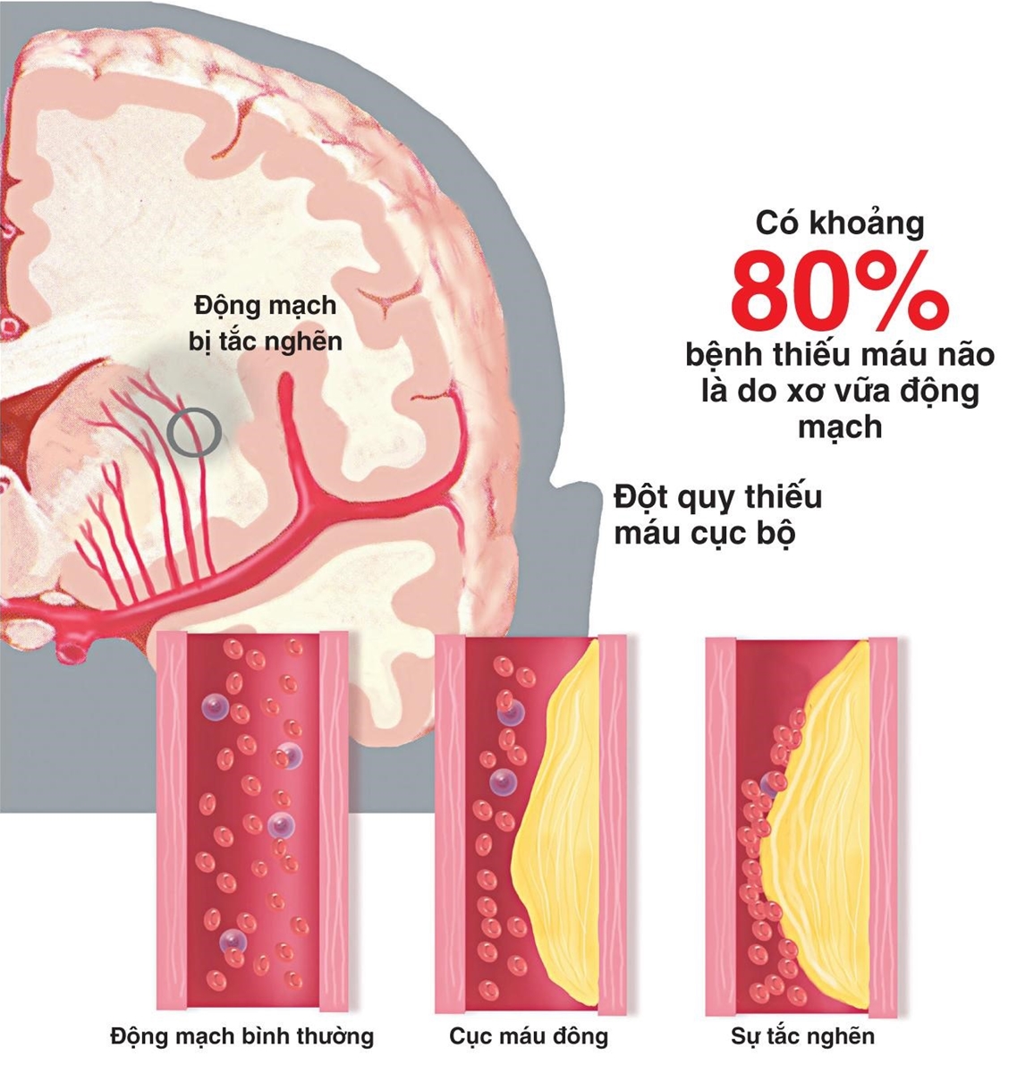 rối loạn tuần hoàn não