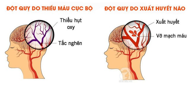 rối loạn tuần hoàn não uống thuốc gì