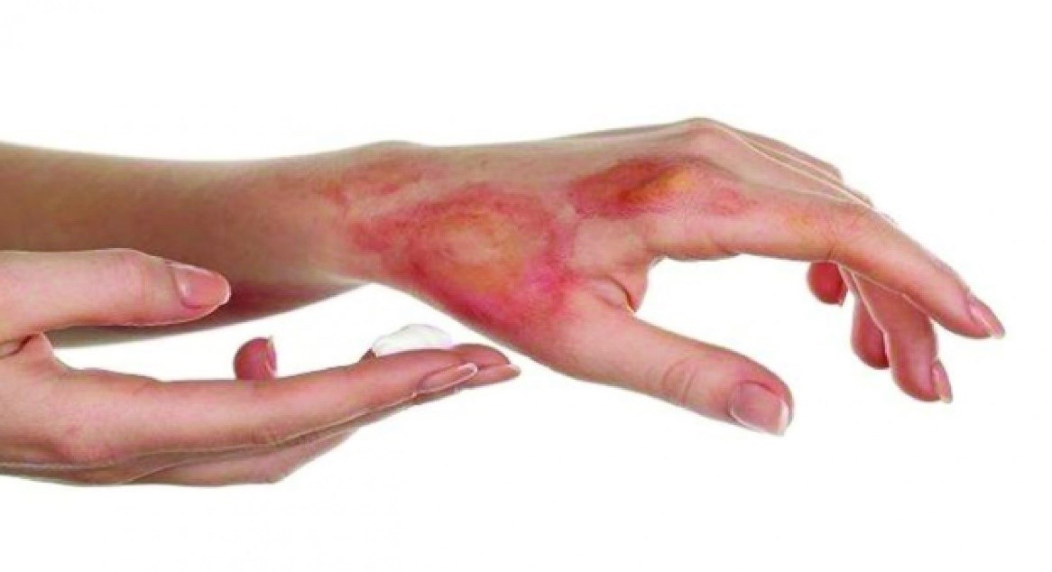 rửa vết bỏng bị vỡ bằng gì