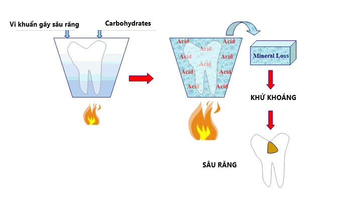 sâu răng không nên ăn gì