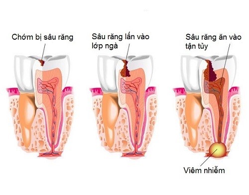 Sâu răng ăn vào tuỷ